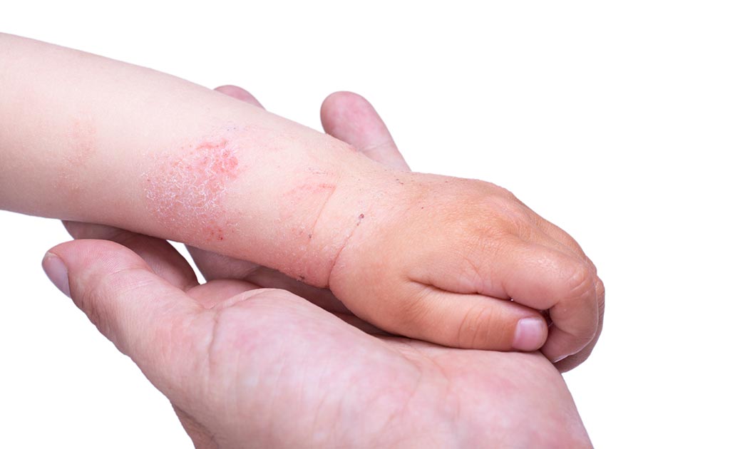 Hard Water Linked To Risk Of Itchy Red Rash In Infants