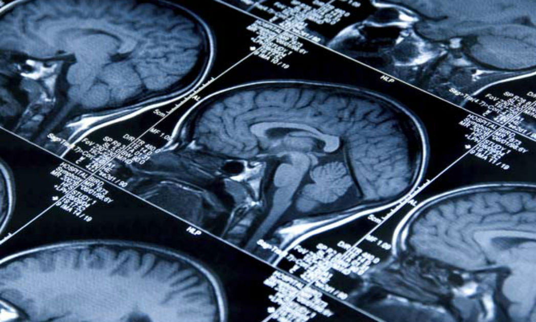 Over 2,500 Indian Children Suffer From Brain Tumour Every Year: Experts