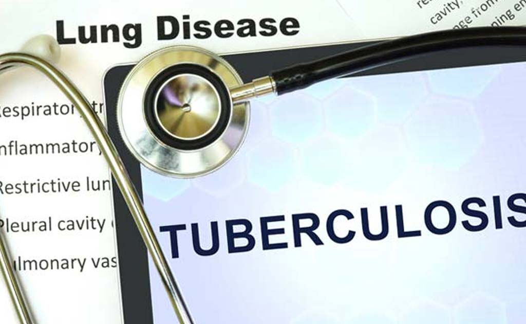Research On Tuberculosis A National Priority: Study