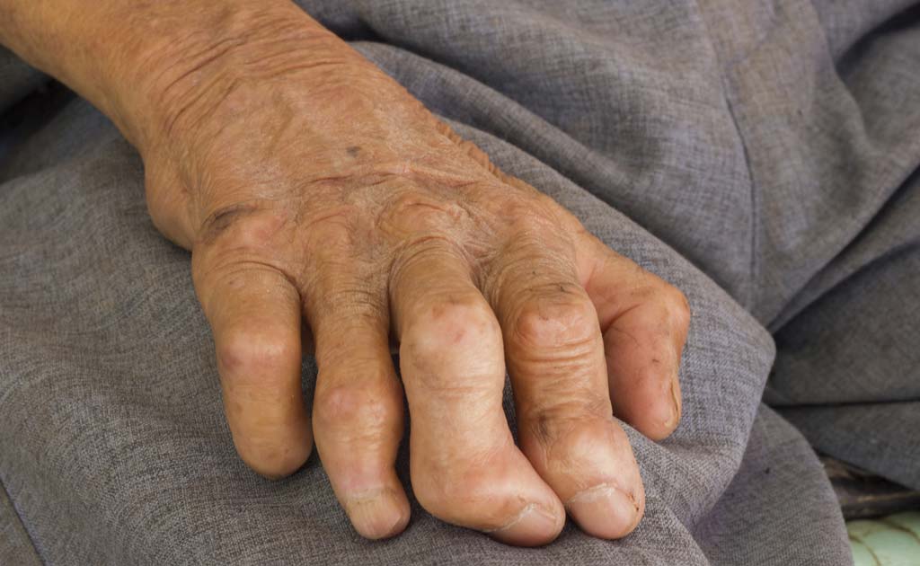 India Launches Biggest Leprosy Eradication Campaign