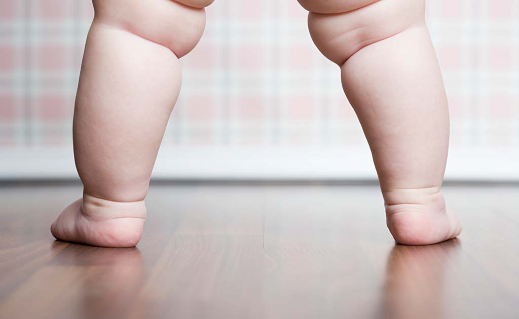 Study Finds Evidence Linking Caesarean Delivery And Childhood Obesity