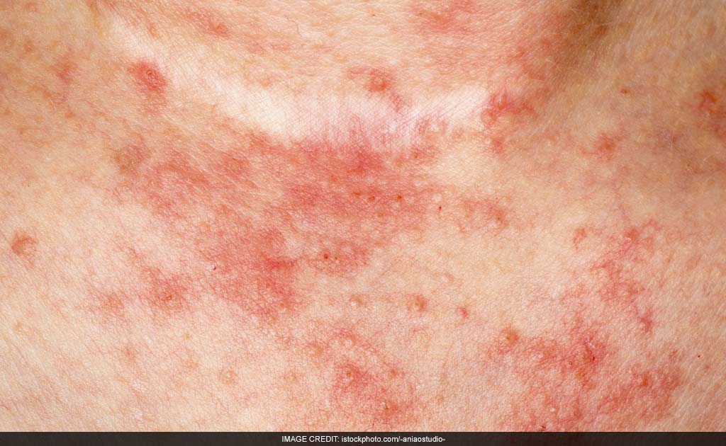 Research Links Eczema, Hay Fever To Early Antibiotic Use