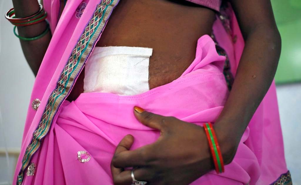 Supreme Court Bans Sterilisation Camps For Women, Activists Laud The Move