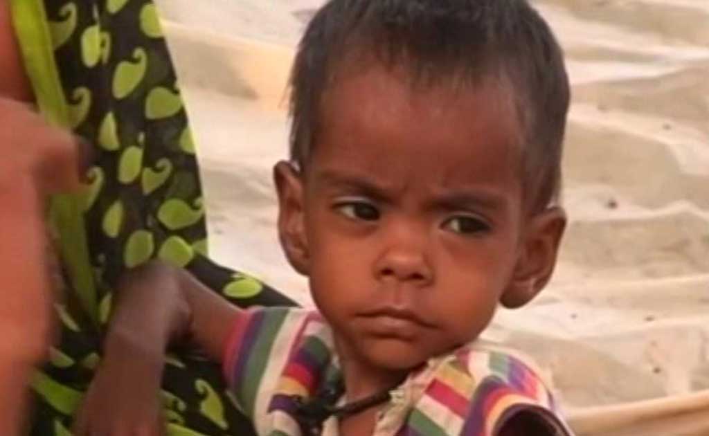 Malnourishment Rampant In Madhya Pradesh Village, Kids Battle For Life