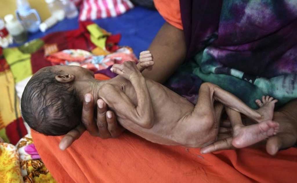 5 in 6 Infants Undernourished In Developing Countries: UNICEF