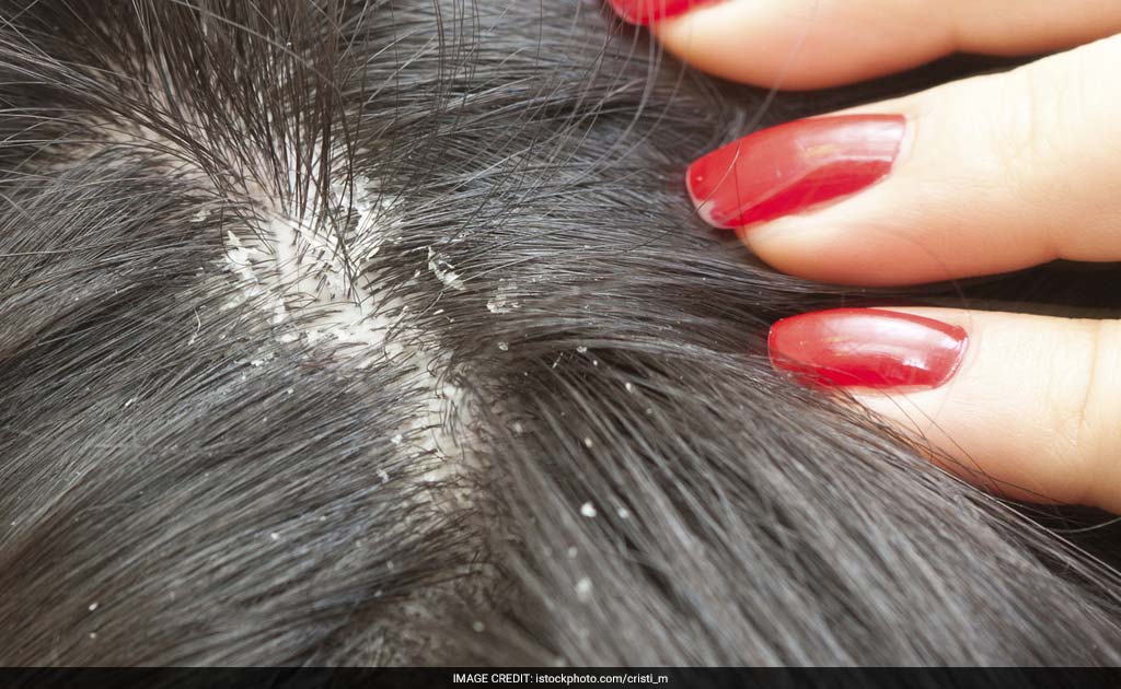 Stress Hormone Levels In Hair Can Predict IVF Success: Study Stress Hormone Levels In Hair Can Predict IVF Success: Study