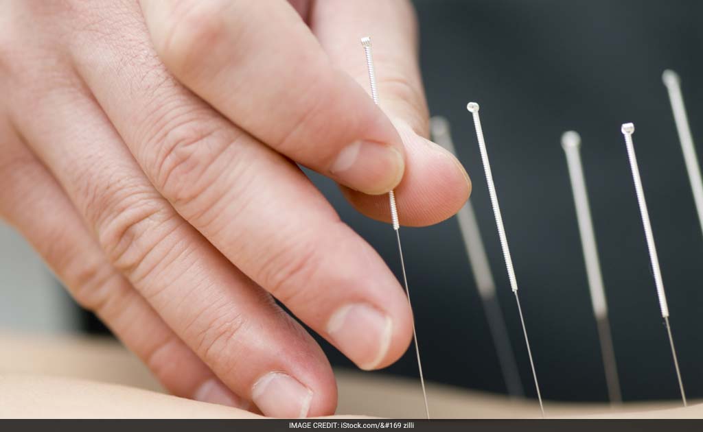 Acupuncture Beneficial In Lowering Hypertension: Study