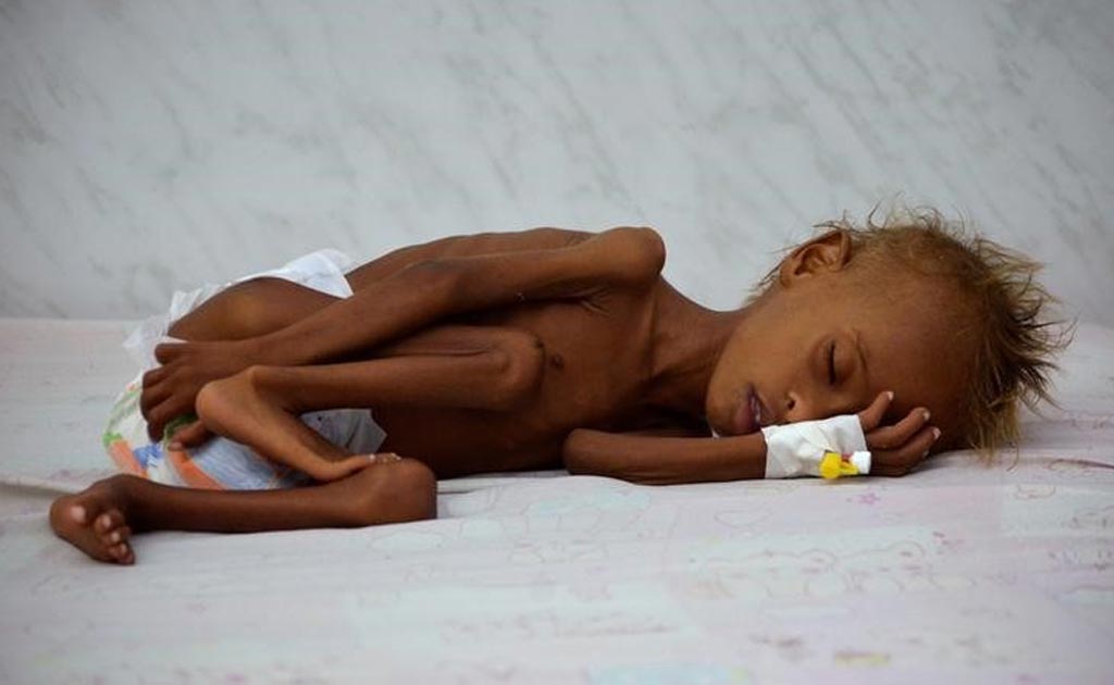 Nearly 800 Million People Go To Bed Hungry Each Night: UN Agency