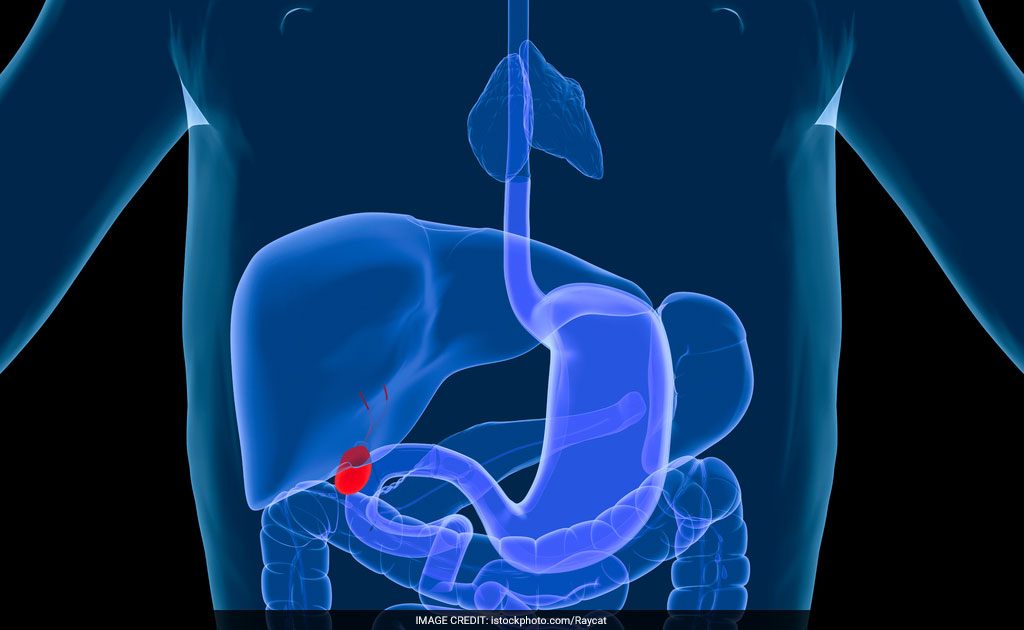 Life Span Of Gall Bladder Cancer Patients Can Improve, Say Doctors Life Span Of Gall Bladder Cancer Patients Can Improve, Say Doctors