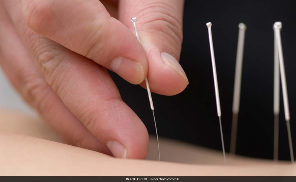 Acupuncture To Reduce Excessive Crying In Babies, Shows Study