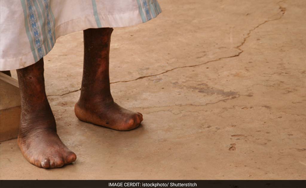 Anti-Leprosy Day: Work Together To Eliminate Stigma, Says PM Narendra Modi