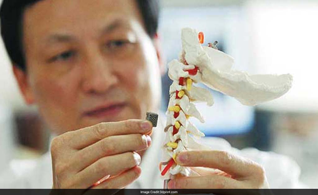 In A First, Surgeons Implant 3D-Printed Vertebrae, Help Woman With Spinal Tuberculosis Walk Again