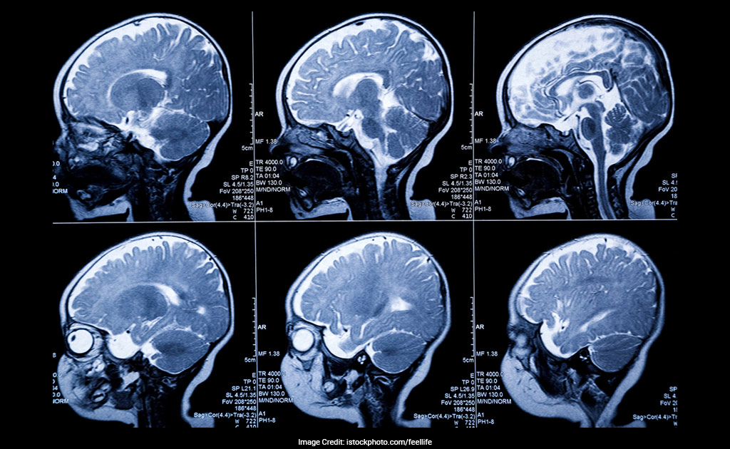 MRI Scans Can Predict Babies At Risk Of Autism: Study