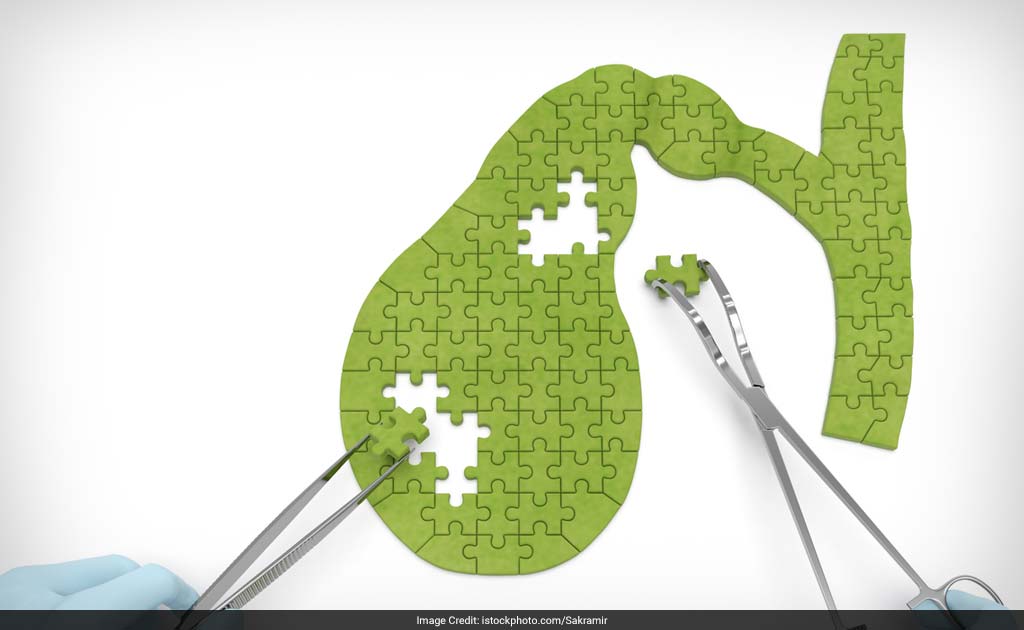 Researchers Identify Genetic Links To Gall Bladder Cancer Researchers Identify Genetic Links To Gall Bladder Cancer