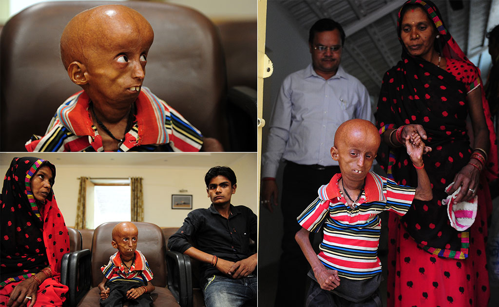 He Suffers From Rare Disease That Affects 1 In 4 Billion. Help Finally Arrives