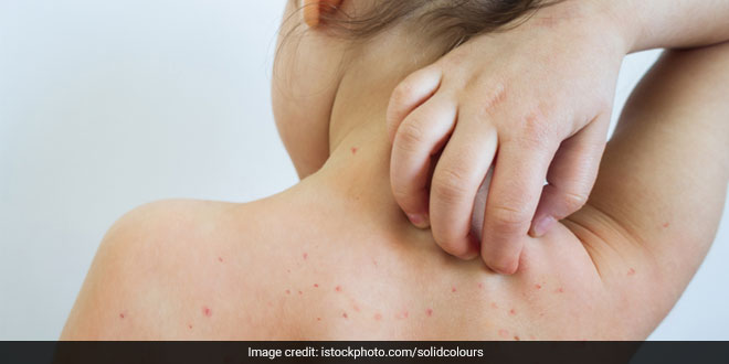 Is Skin Rash A New Covid 19 Symptom Experts Explain Coronavirus Outbreak