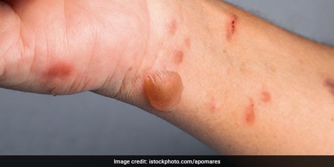 Tomato Flu: बच्चों के शरीर पर टमाटर जैसे लाल फफोले नए वायरस का आतंक, यहां जानें टोमैटो फ्लू के बारे में सब कुछ Tomato Flu: बच्चों के शरीर पर टमाटर जैसे लाल फफोले नए वायरस का आतंक, यहां जानें टोमैटो फ्लू के बारे में सब कुछ