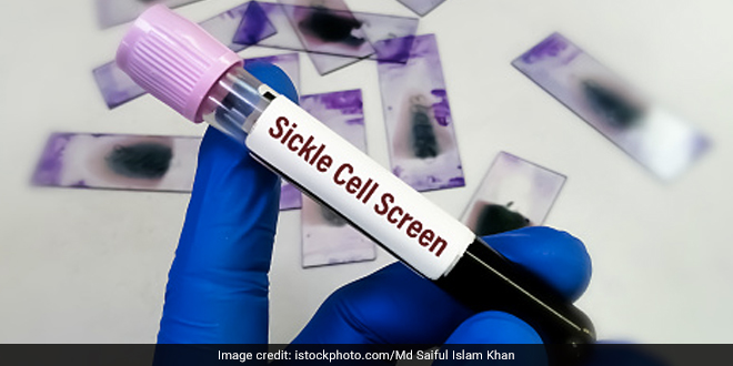 सिकल सेल बीमारी से जुड़े भेदभाव को मापने का भारत का वैज्ञानिक पैमाना तैयार